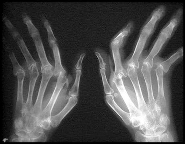 X -ray слика на рацете погодени од артроза