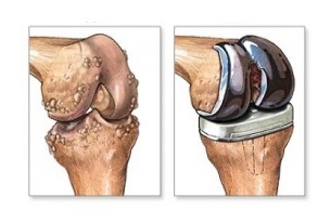 замена на коленото за артроза