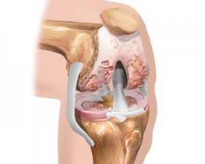 почетната фаза на артроза на колената
